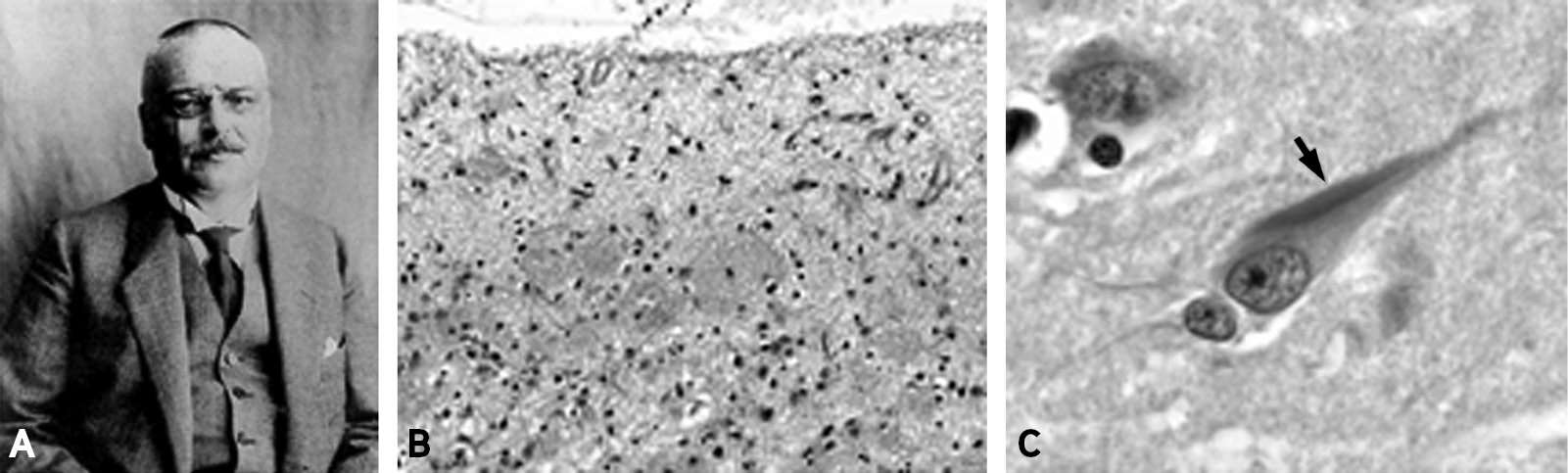 The characteristic pathologic features of Alzheimer disease (AD) The characteristic pathologic features of Alzheimer disease (AD)