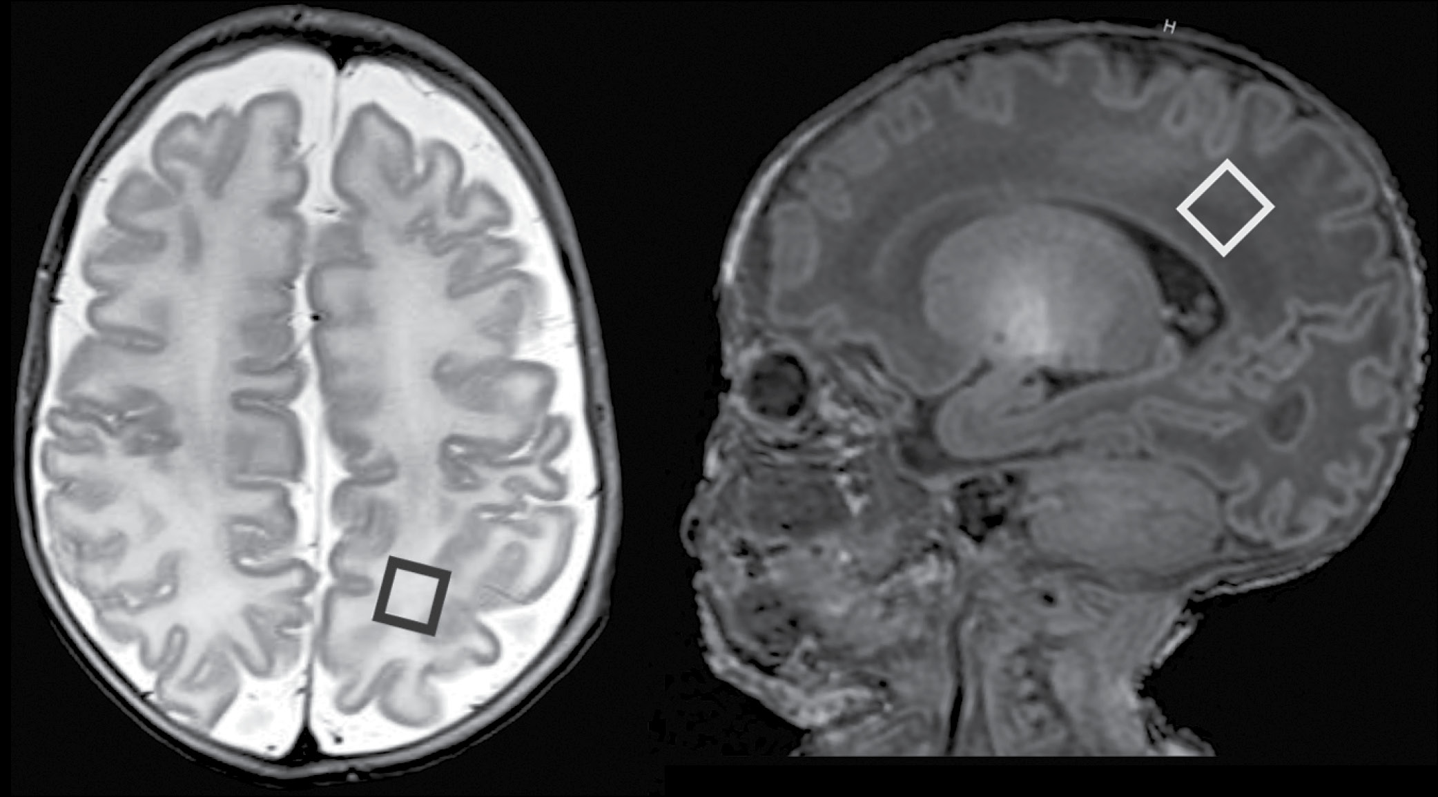 Axial T2-weighted (left) and sagittal T1-weighted (right) MR images Axial T2-weighted (left) and sagittal T1-weighted (right) MR images