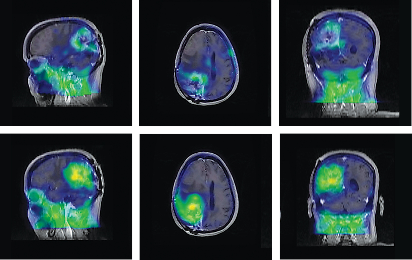 18F-FHBG head PET images superimposed over corresponding MRI images 18F-FHBG head PET images superimposed over corresponding MRI images