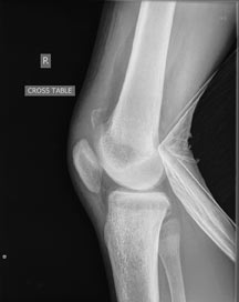 1-Bilateral_Knee_Pain_1