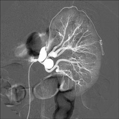 2-RA_aneurysm_ANGIO_1