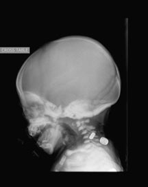 3-Noncontrast-Head-CT_1