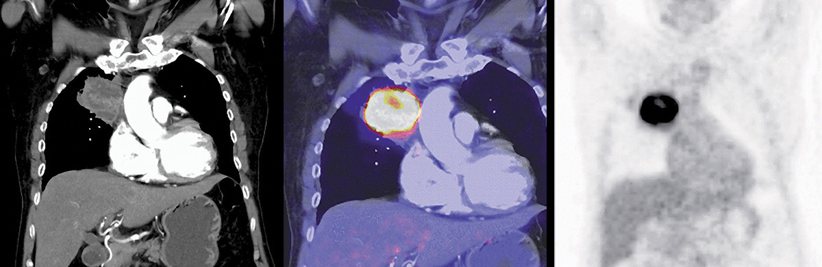 PET/MR Lung Cancer