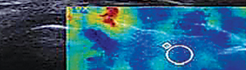 New Elastography image for Collection