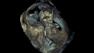 Fetal 3D ultrasound video Fetal 3D ultrasound video