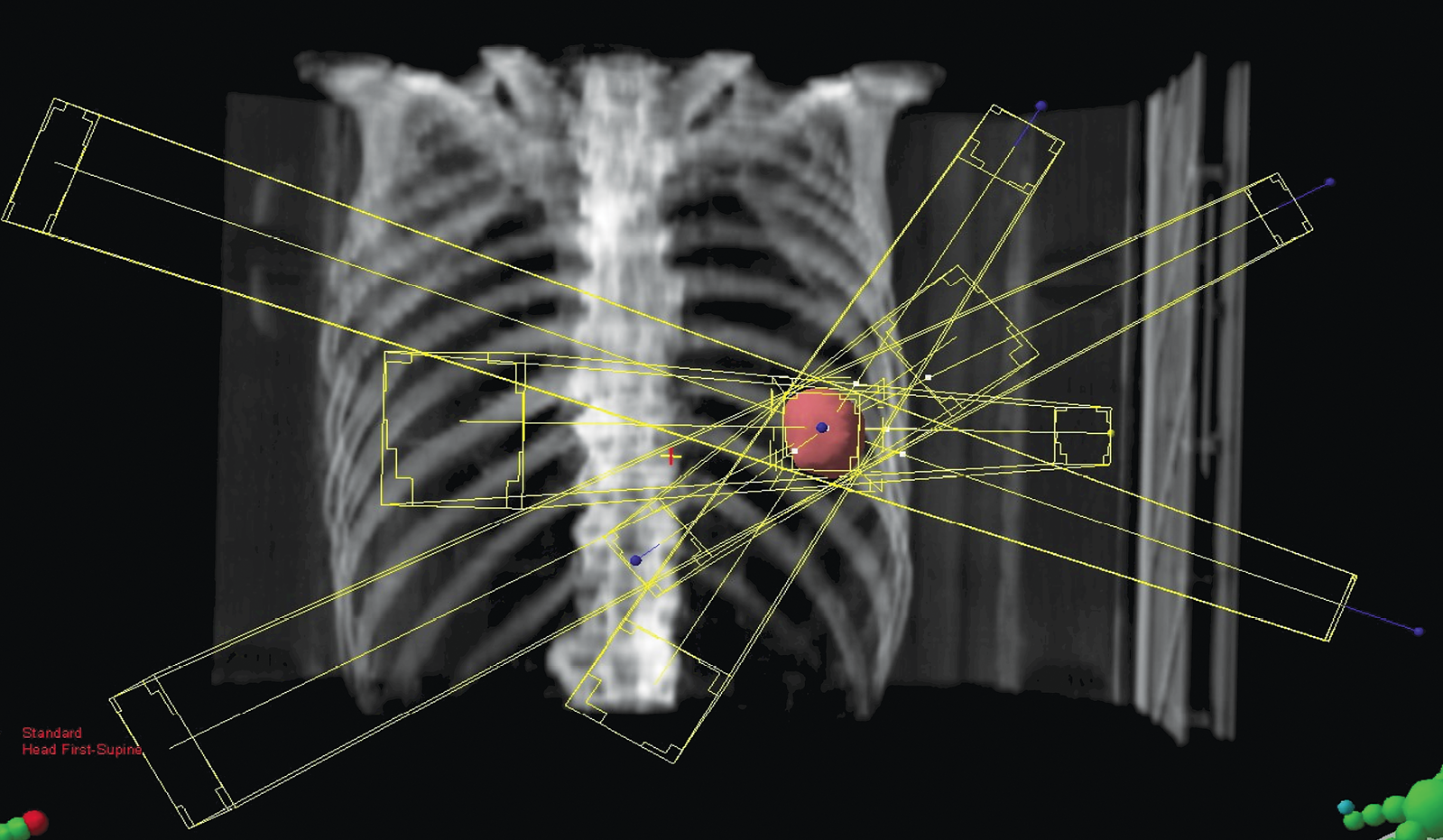 Lung Cancer Radiation Treatment