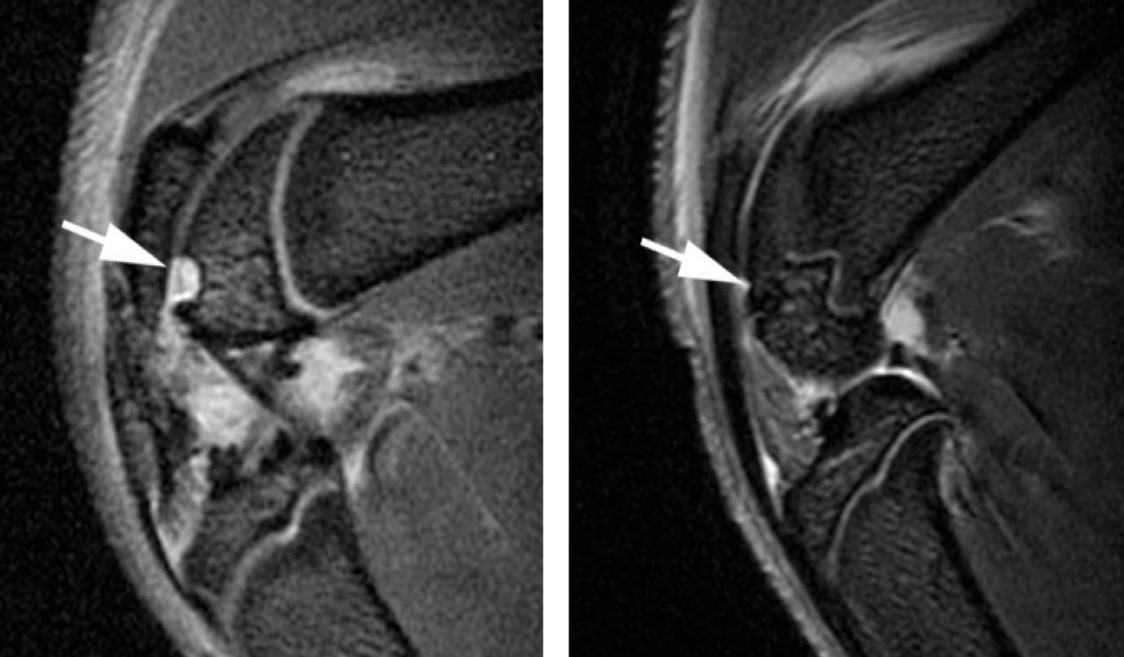 MR image of ferumoxytol labeled stem cells implanted in a rat cartilage defect model MR image of ferumoxytol labeled stem cells implanted in a rat cartilage defect model