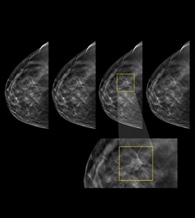 mammography-xray-cv