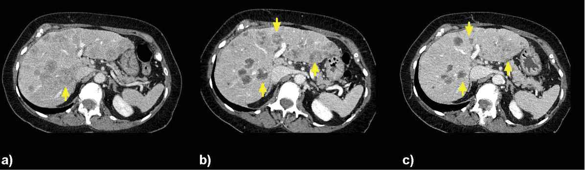 Images of a 76-year-old woman with (a) multiple liver lesions in both lobes treated with selective right hepatic arterial catheterization and infusion of Y-90 followed by treatment of the left lobe 35 days later. Treatment delivered localized radiation at 131Gy and 122Gy to the right- and left-lobe tumors targeted with Y-90, respectively; (b) CT demonstrates treatment changes at 1 month and (c) 2 months imaging post-right lobe treatment; and (c) 1 month post-left lobe treatment confirming globally decreased hepatic disease burden. This patient had stable bone metastases without extrahepatic disease progression for 111 days after the first Y-90 treatment.