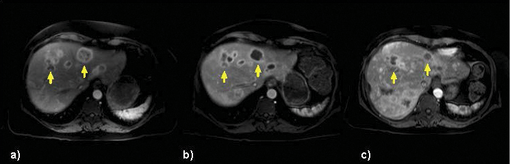 An image of a 55-year-old woman with (a) multiple tumors on MR imaging treated with selective right hepatic arterial catheterization and infusion of Y-90 followed by treatment of the left lobe 46 days later. Sequential bilobar treatment delivered 118Gy and 146Gy to the right- and left-lobe tumors targeted with Y-90, respectively. MR imaging demonstrated posttreatment changes at (b) 4 months and (c) 7 months imaging post right-lobe treatment and at (b) 3 months and (c) 6 months post left-lobe treatment confirming globally decreased multifocal bilobar disease burden.
