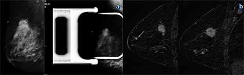 Figure 1: Mammography and MR imaging in a 46-year-old woman with a palpable mass in the right breast. 