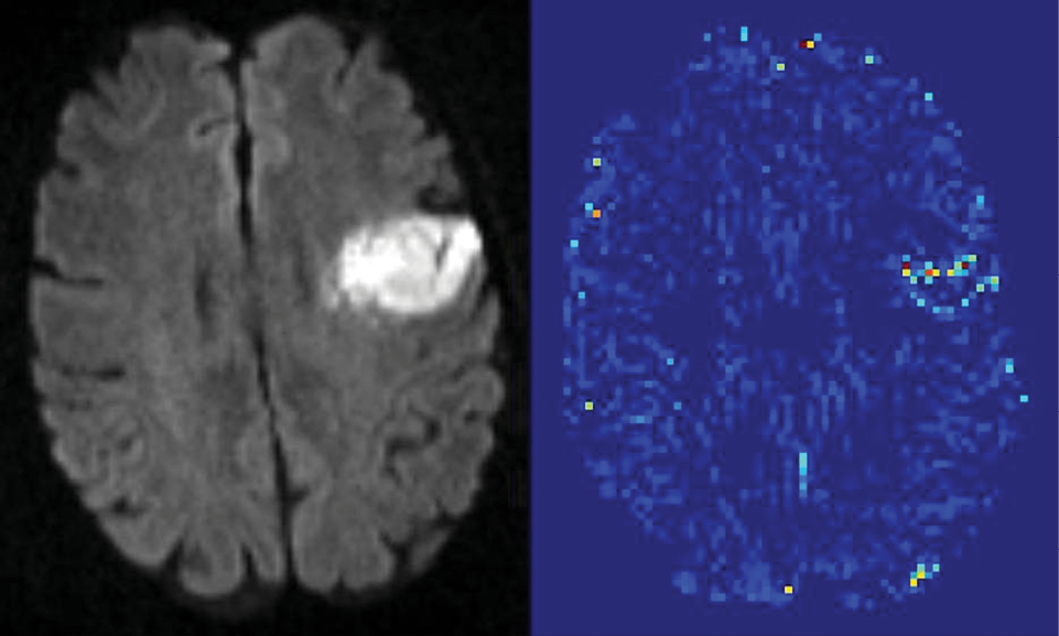 Shown are two different MRI images of the same part of the brain of the same patient.