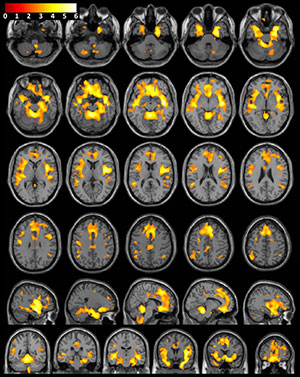 T1-weighted MR imaging examination of the brain with superimposed population-level T-value map
