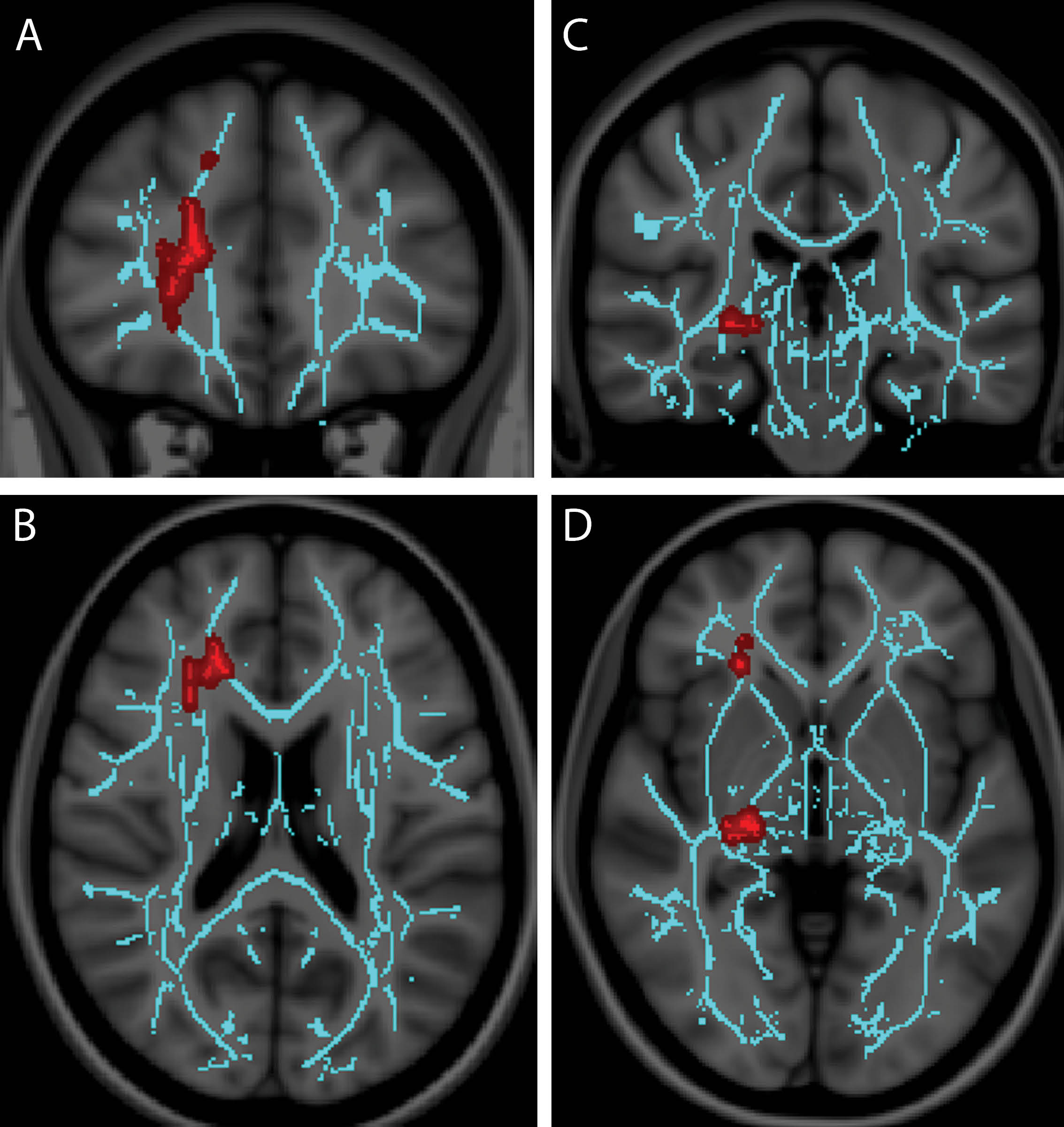 Recent research in Radiology suggests a role for diffusion tensor imaging (DTI) in mild traumatic brain injury (mTBI) diagnosis