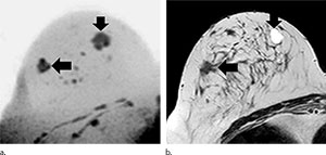 Figure 3. Images show example of a screening-detected lesion in a 51-year-old breast cancer screening participant 