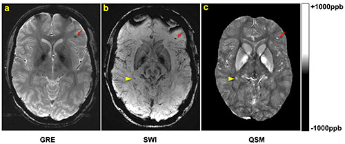 A, gradient-recalled-echo (GRE), B, susceptibility-weighted imaging (SWI), and, C, quantitative susceptibility mapping (QSM) images in a patient with traumatic brain injury.