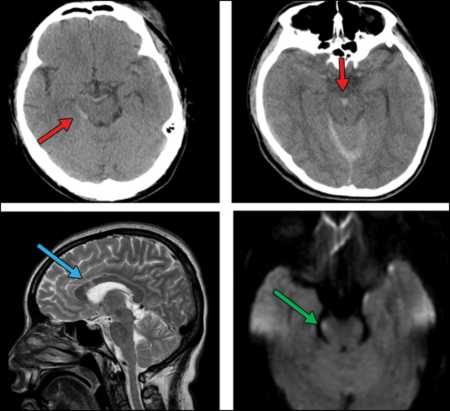 An image from Dr. Mbemba's research showing the initial CT performed 50 minutes after onset showed the presence of midline (perimesencephalic) subarachnoid hemorrhage