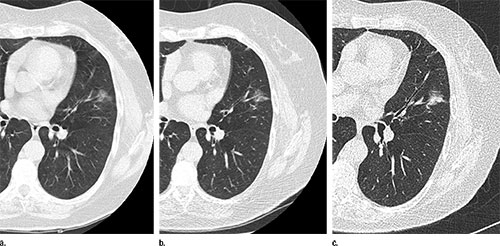 CT images in a 68-year-old smoker show 