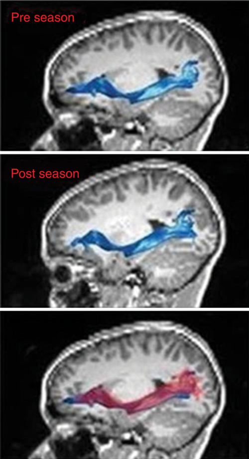 MR images of left inferior fronto-occipital fasciculus