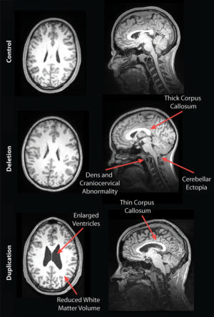 mri-reveals-striking-brain-differences-in-people | RSNA