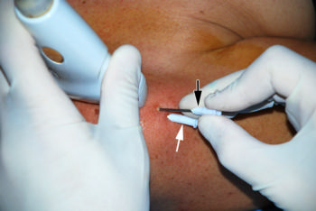 Positioning of needles in a 56-year old woman treated 