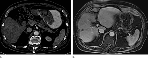 Images show (a) contrast material–enhanced CT scan before yttrium 90 of an 87-year-old man with 4-cm hepatocellular carcinoma in right lobe