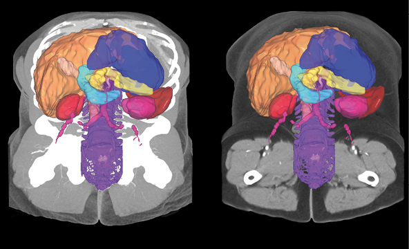 Color-coded mapping of the segmentation of the abdominal organs 