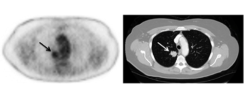 Images show examples of pathologically confirmed distant metastasis detected by using PET/CT