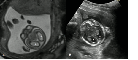 Fetus at 18 SG + 3 gg with a diagnosis hydrocephalus