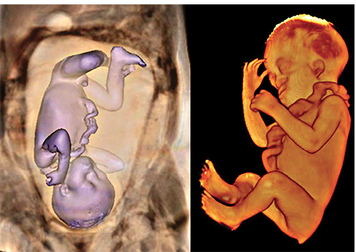 3-D MRI showing a 27-week fetus with brachycephaly, low ear implantation, syndromic profile and vestigial tail
