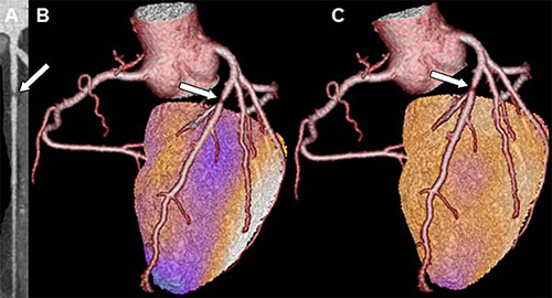 Images in a patient with a matched cardiac hybrid finding