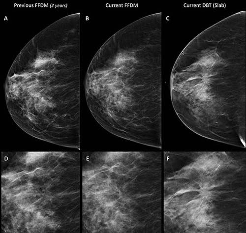 Images in a 70-year-old woman in the digital breast tomosynthesis (DBT) plus digital mammography (DM) study arm