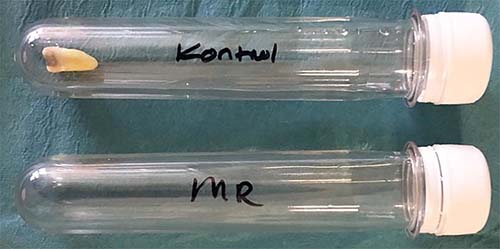Sample tubes containing, top, tooth with dental amalgam in artificial saliva in preparation for testing and, bottom, artificial saliva only