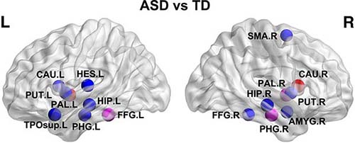 Brain regions with significant between-group differences in nodal efficiency