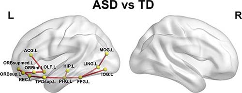 Networks showing increased structural connections in children with autism-spectrum disorder (ASD) compared with children with typical development (TD)