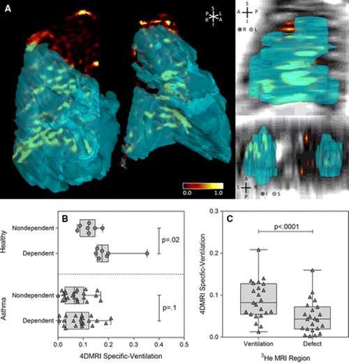 Images show spatial correspondence of free-breathing four-dimensional (4D) MR imaging (4DMRI) specific ventilation and helium 3 (3He) MR imaging static ventilation maps