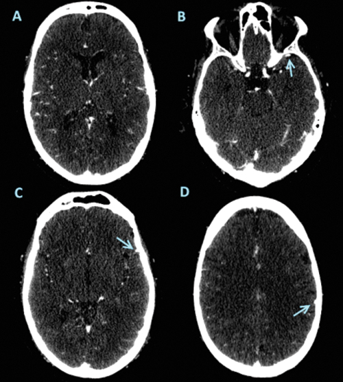 Images from baseline CT angiography in 61-yearold man 