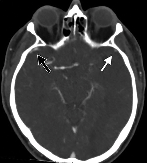 Image from a baseline CT angiography in 61-year-old man 