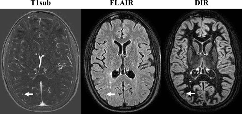 MRI-Monitoring-MS | RSNA
