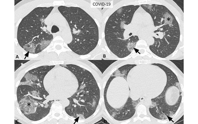 chest pattern