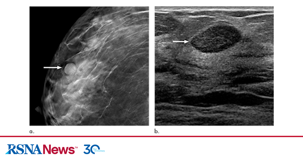 Small breast cancer, Radiology Case