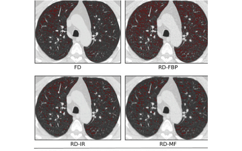 Low Dose CT For COPD RSNA