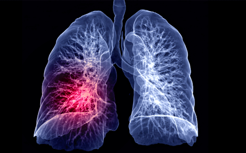 lung cancer screening compliance feature