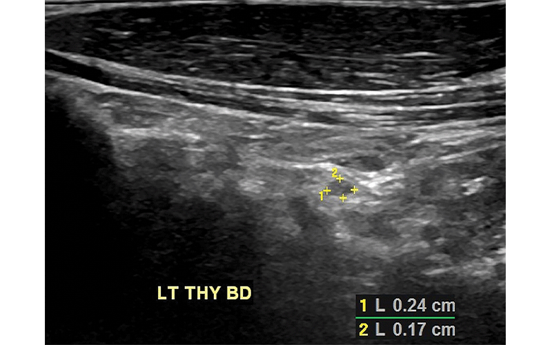 Frates thyroid feature