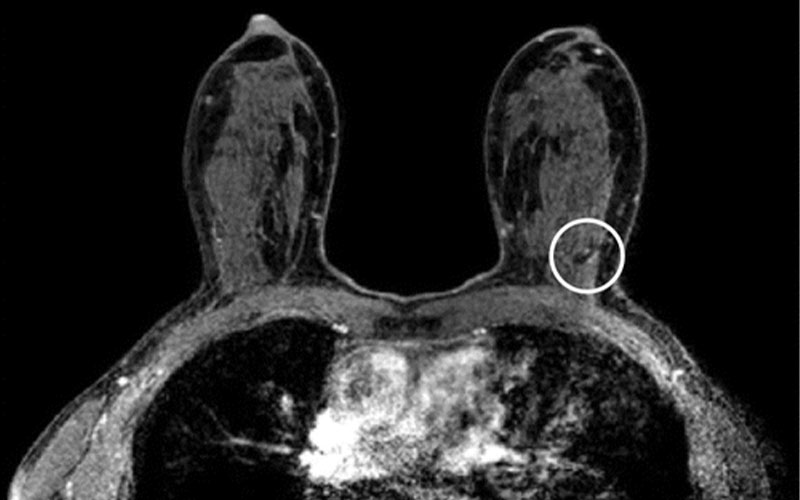 MRI For Dense Breasts RSNA