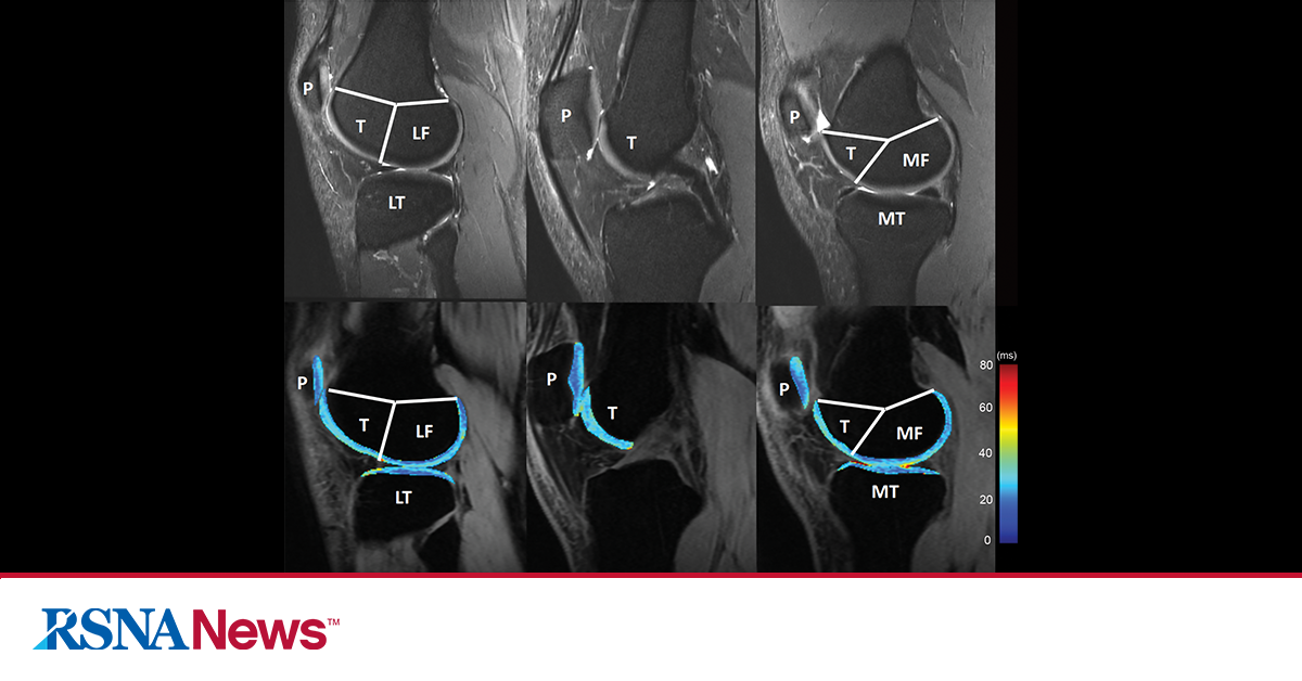 New QIBA Profile Knee Cartilage MRI RSNA