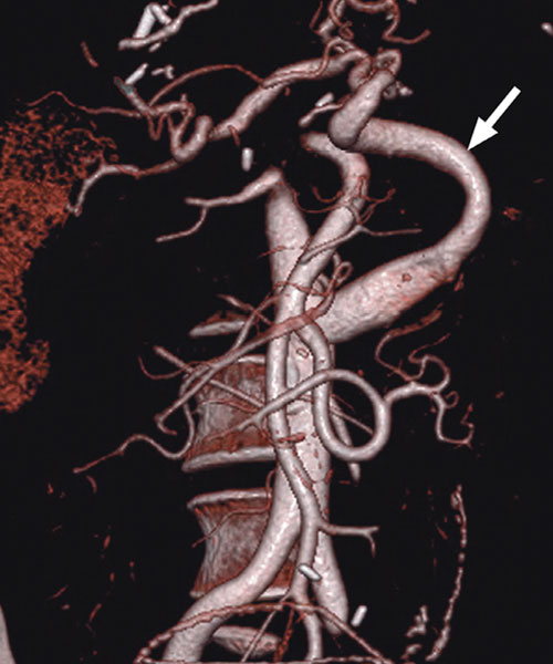 Брукмейер рисунок 2