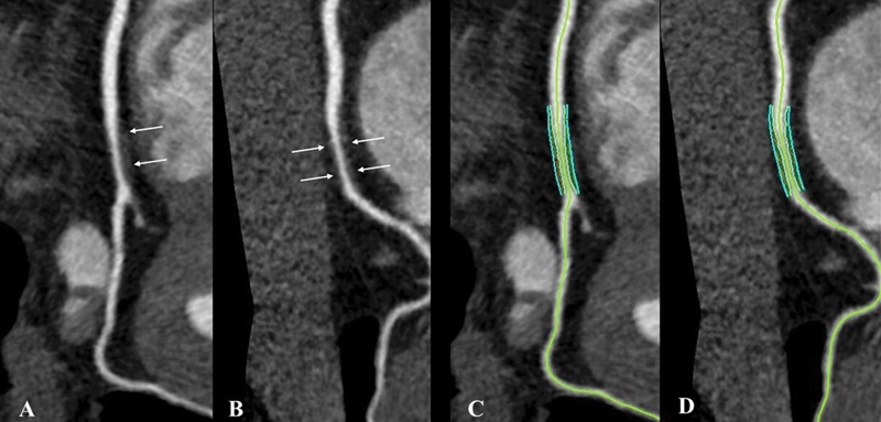 Coronary Plaque with CT