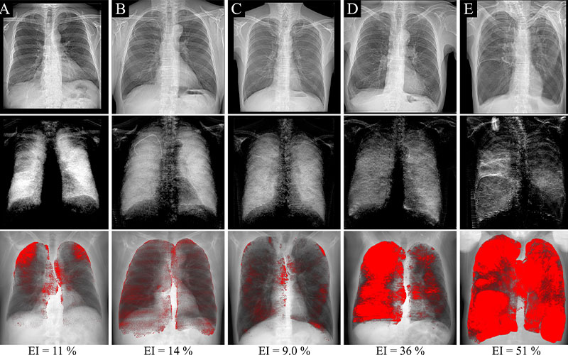 Emphysema Chest X Ray