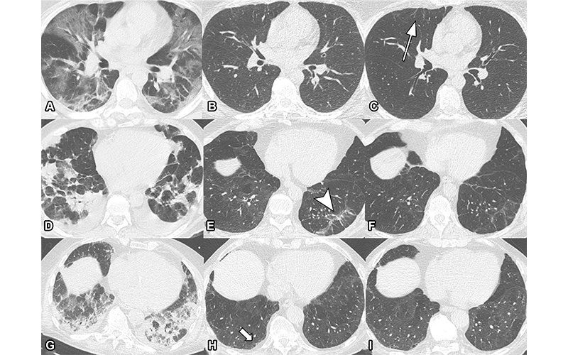 Schwabl-Release-Fig-4 Lung Damage May Persist Long After COVID-19 Pneumonia